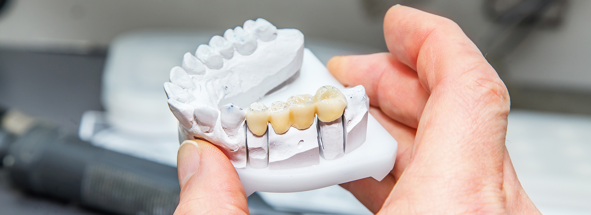 All About Smiles | Root Canals, Dental Fillings and Digital Radiography