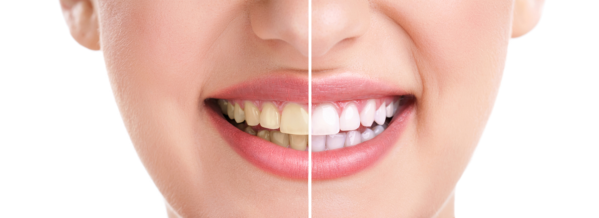 All About Smiles | Dental Fillings, Invisalign reg  and Extractions