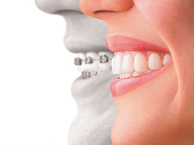 All About Smiles | Night Guards, Preventative Program and Invisalign reg 