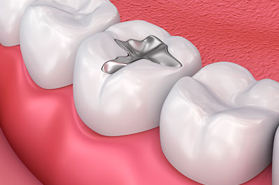All About Smiles | Crowns  amp  Caps, Pediatric Dentistry and Dental Fillings