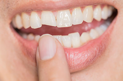 All About Smiles | Invisalign reg , Pediatric Dentistry and Preventative Program