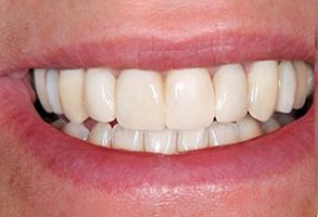 All About Smiles | Invisalign reg , Extractions and CEREC