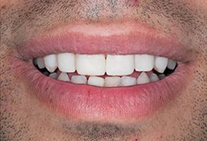 All About Smiles | Crowns  amp  Caps, Cosmetic Dentistry and Dentures