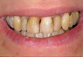 All About Smiles | Snoring Appliances, Periodontal Treatment and Veneers